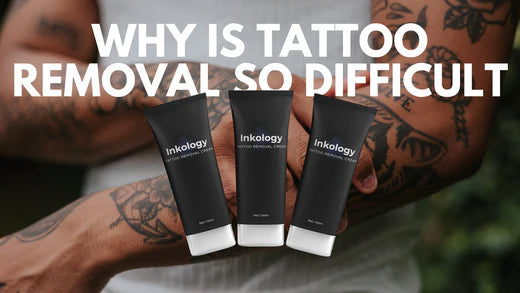 Why Is Tattoo Removal So Difficult?