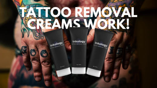 Tattoo Removal Creams Work and Here is How